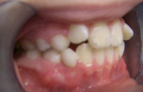 Traitement d'orthodontie d'une enfant à Marseille : deux canines incluses dans l'os