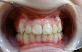 Traitement d'orthodontie d'une enfant à Marseille : deux canines incluses dans l'os