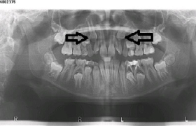 Traitement d'orthodontie d'une enfant à Marseille : deux canines incluses dans l'os