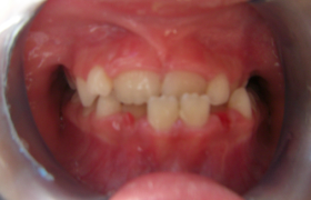 Traitement d'orthodontie sans extractions de dents définitives Voir(onglet actif)