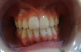 Traitement d'orthodontie sans extractions de dents définitives Voir(onglet actif)