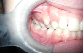 Traitement d'orthodontie d'une jeune fille souffrant de malpositions dentaires généralisées