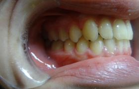 Traitement d'orthodontie d'une jeune fille souffrant de malpositions dentaires généralisées
