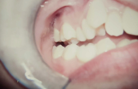 Traitement orthodontique avec sourire inesthétique
