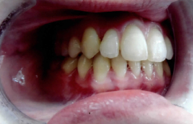 Traitement orthodontique avec sourire inesthétique