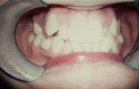 Traitement orthodontique avec sourire inesthétique