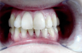 Traitement orthodontique avec sourire inesthétique