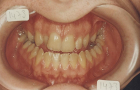  Traitement d'orthodontie d'une classe III