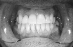Remédier à un sourire disgracieux avec un appareillage en céramique
