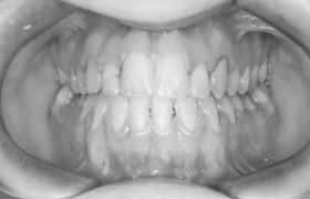  Traitement d'orthodontie d'une classe III