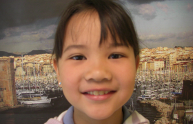 Traitement d'orthodontie pour un décalage dentaire d'une jeune fille à Marseille.