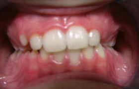 Traitement d'orthodontie sur un jeune adolescent de Septèmes les vallons