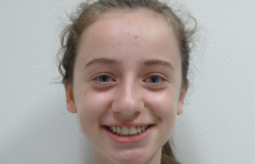 Traitement d'orthodontie d'une enfant de 9 Ans