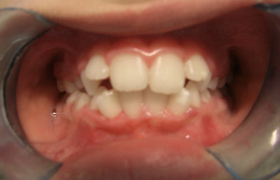 Traitement d'orthodontie d'une enfant de 9 Ans