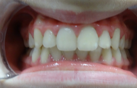 Traitement d'orthodontie d'une enfant de 9 Ans
