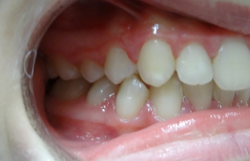 Traitement d'orthodontie d'une enfant de 9 Ans