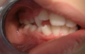 Traitement d'orthodontie d'une enfant de 9 Ans
